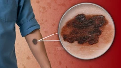 Chuyên gia chỉ cách nhận biết dấu hiệu ung thư da qua nốt ruồi