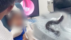 Gắp con đỉa trong đường thở của bệnh nhi 5 tuổi sau 1 tuần liên tục ho ra máu