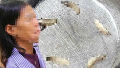 Bác sĩ gắp ổ giòi trong hốc mũi của nữ bệnh nhân 60 tuổi
