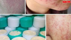 Rước họa vì làm đẹp bằng “kem trộn” chứa Coticoid