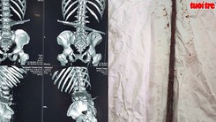 Cứu sống cụ ông bị thanh sắt dâm xuyên bụng, cột sống và thắt lưng