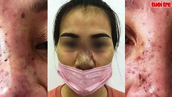 Cẩn thận khi tiêm chất làm đầy filler