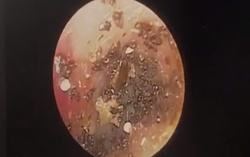 Dog ticks found in ear of 9-year-old girl in southern Vietnam
