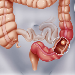 Cách phát hiện sớm polyp đại tràng để tránh ung thư