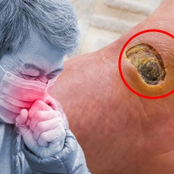 Bệnh sốt mò - mối nguy hiểm từ những vết loét vô hại