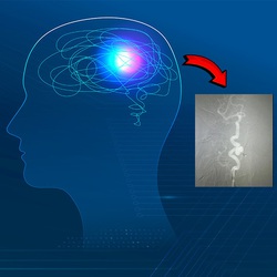 Cách nhận biết phình động mạch não - chứng bệnh gây đột tử