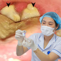 Triệu chứng và cách phòng tránh bệnh bạch hầu