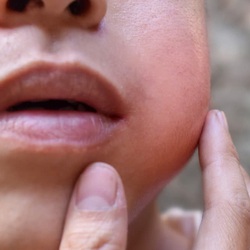 Tự ý điều trị mụn nhọt có thể nguy hiểm tính mạng