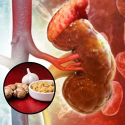 Tỏi và gừng có làm tan sỏi thận sau 21 ngày như thông tin lan truyền?