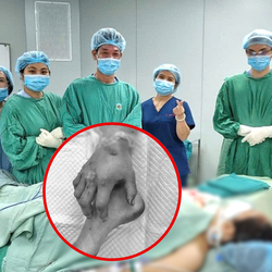 Nối thành công bàn tay cho sản phụ sau gần hai tháng ‘nuôi chi’ ở cẳng chân