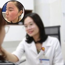 Tự ý dùng tretinoin để 'đổi da cấp tốc' đón Tết, nhiều chị em phải nhập viện điều trị
