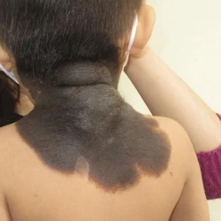 Bớt đen bẩm sinh ở trẻ, cẩn trọng nguy cơ ung thư da