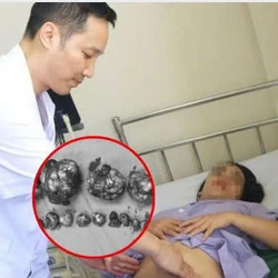 Phẫu thuật và bảo tồn tử cung cho nữ bệnh nhân có 19 khối u xơ hiếm gặp