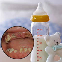 Chú ý: Thói quen bú bình ảnh hưởng đến phát triển răng miệng ở trẻ em