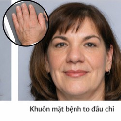 Bàn tay và bàn chân ngày càng to bất thường là dấu hiệu cần lưu ý