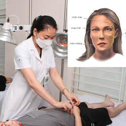 Tại sao nhiễm lạnh dễ dẫn đến liệt dây thần kinh số 7?