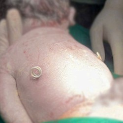 Em bé được cứu chữa từ trong bụng mẹ, chào đời với 'đôi cánh tí hon'