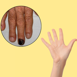 Móng tay màu đen như tụ máu là dấu hiệu của bệnh gì, có nguy hiểm?