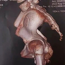 Bé gái mắc hội chứng người hóa đá cực hiếm: Bác sĩ Bệnh viện Nhi đồng Thành phố khuyến cáo gì?
