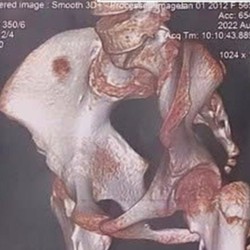 Bác sĩ nói về ca bệnh ‘người hóa đá’ lần đầu Việt Nam chẩn đoán thành công 