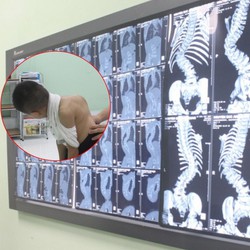 Dấu hiệu nhận biết sớm cong vẹo cột sống ở trẻ