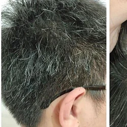 Vì sao nhiều người trẻ tóc bạc sớm?