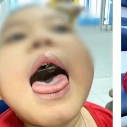 Bé trai 4 tuổi nhiều lần tím tái vì ngưng thở khi ngủ kéo dài