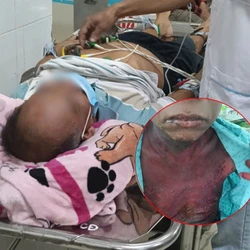 Nhỏ thuốc mắt, người đàn ông 51 tuổi bị hoại tử thượng bì nhiễm độc hiếm gặp