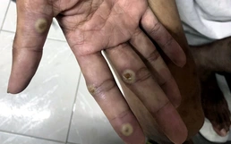 Vietnam’s Dong Nai reports mpox case with unknown source of infection