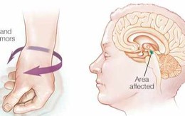 Cắt bỏ ruột thừa sớm, giảm nguy cơ bị Parkinson