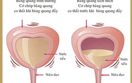 Khi người lớn... són tiểu