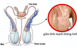 Giãn tĩnh mạch thừng tinh có ảnh hưởng chuyện có con?