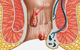 Bị trĩ, nên cắt hay điều trị thuốc Nam?