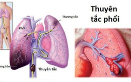 Căn bệnh có thể dẫn tới tử vong, nhưng thường không có triệu chứng