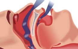 Ngưng thở lúc ngủ - CSA nhẹ hơn OSA?