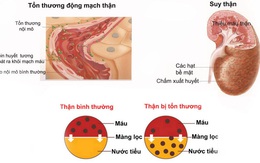 Những biến chứng nguy hiểm của bệnh sỏi thận, bạn có biết?