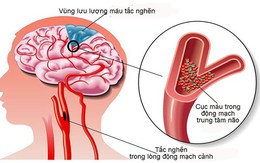 Hoạt huyết dưỡng não: Không nên ngộ nhận