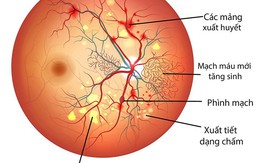 Bệnh võng mạc đái tháo đường - nguyên nhân chính gây mù lòa
