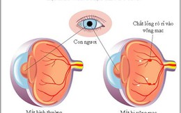 Các bệnh võng mạc thường gặp