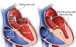 Thế nào là bệnh cơ tim phì đại