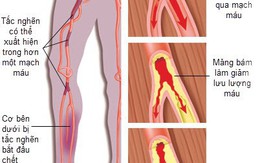 Tắc động mạch ngoại biên: âm thầm nhưng nguy hiểm