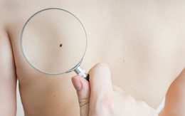 Nốt ruồi hay u hắc tố?