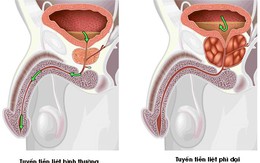 U xơ tuyến tiền liệt - nỗi lo của nam giới tuổi trung niên