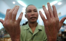 Không nên kỳ thị người bị vảy nến
