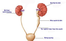 Những giải pháp tích cực khi bị thận ứ nước