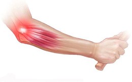 Hội chứng Tennis elbow