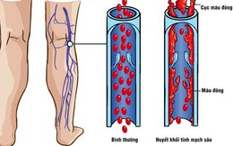 Những điều cần biết về bệnh huyết khối tĩnh mạch sâu