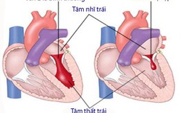 Hẹp van hai lá