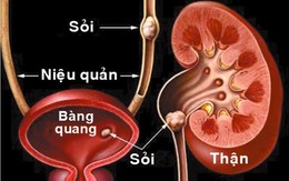 Sỏi đường tiểu