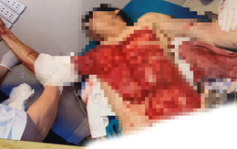 Dốc toàn lực cứu chữa nạn nhân tai nạn thương tâm do máy bóc gỗ